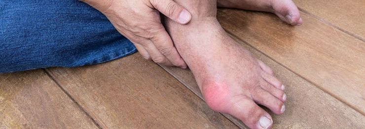 Swollen red first metatarsophalangeal joint showing acute gout flare inflammation on a foot