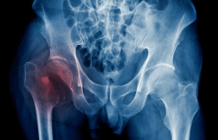 Bone density scan showing osteoporosis screening