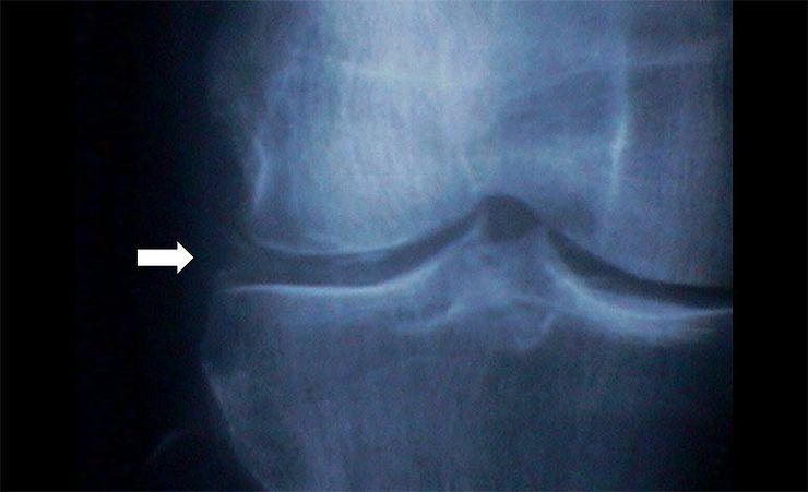 Knee X-ray showing chondrocalcinosis, the calcium deposits characteristic of pseudogout (CPPD)