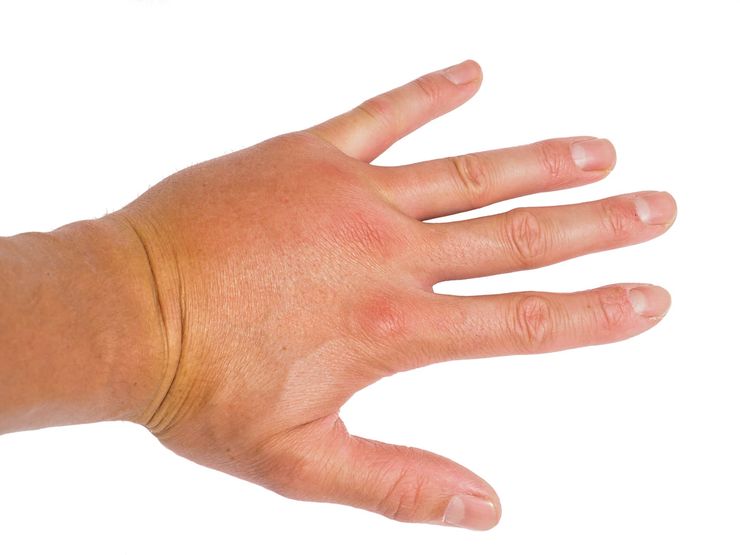 Swollen hand showing joint inflammation from chronic uncontrolled gout