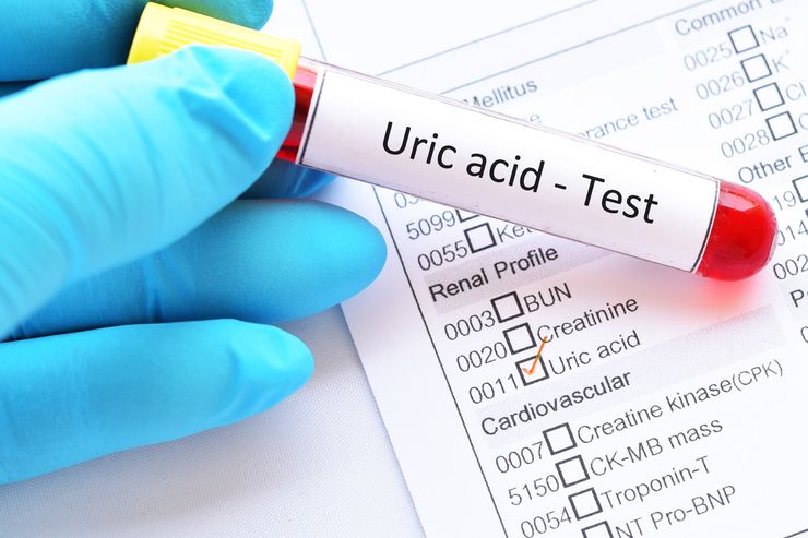 Uric acid blood test tube and laboratory results