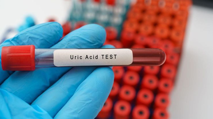 Blood sample tube labeled Uric Acid Test held by gloved hand in laboratory