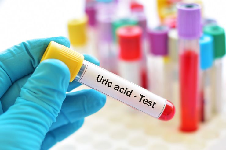 Blood test tube labeled for uric acid testing held in gloved hand