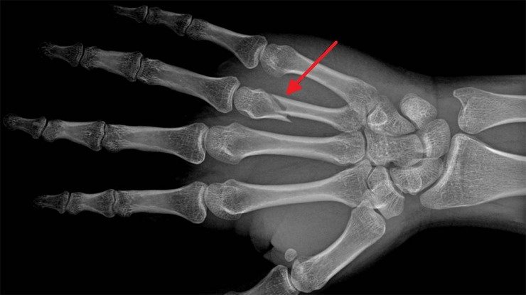 X-ray showing a hand fracture, illustrating bone fragility risk