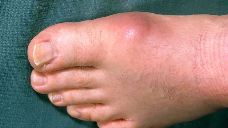 Red, swollen big toe joint during an acute gout flare
