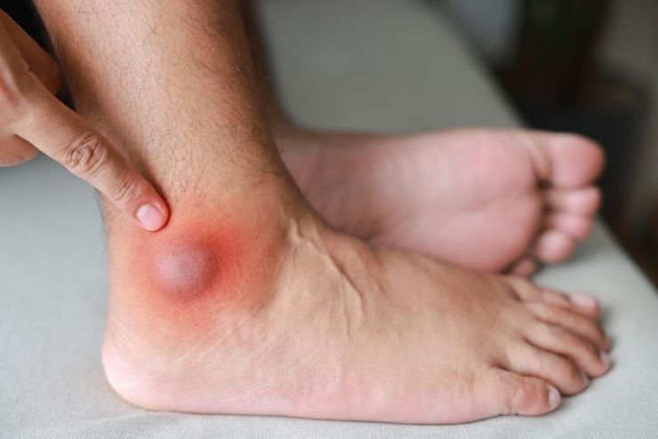 Swollen red ankle and foot from a multi-joint gout flare