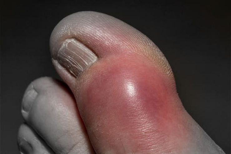 Close-up of a red swollen big toe joint during an acute gout flare