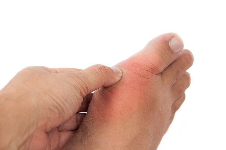 A hand examining the red, swollen big toe joint of a foot during a gout flare
